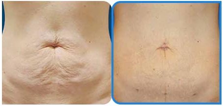 복부 CASE 출산 후 늘어진 복부 탄력 Before / After 10Weeks