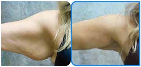 팔 CASE 처진 날갯살 탄력 Before / After 6Weeks