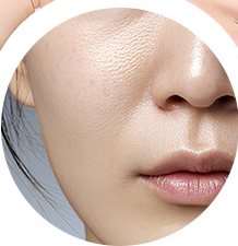 잔주름·깊은주름 — 코옆·입가 주름 피부