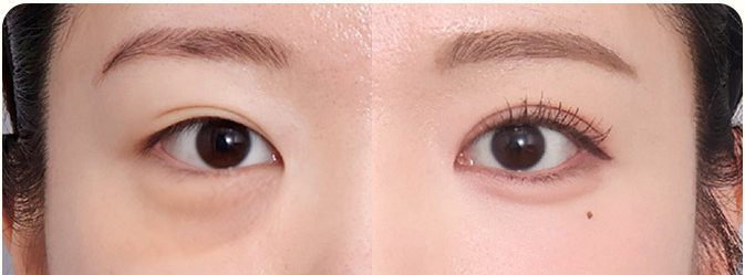 애교살을 살린 눈밑지방재배치 전후 — BEFORE / AFTER 3M