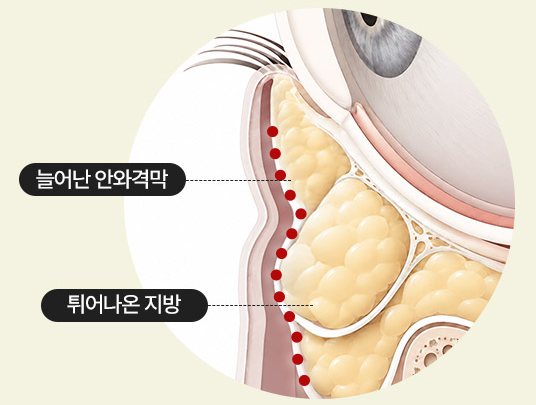 눈밑 단면 도식 — 늘어난 안와격막, 튀어나온 지방