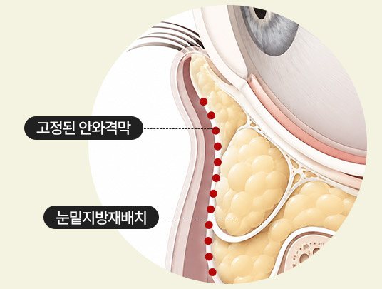 눈밑 단면 도식 — 고정된 안와격막, 눈밑지방재배치