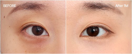눈밑지방재배치 전후 1 — BEFORE / After 1M