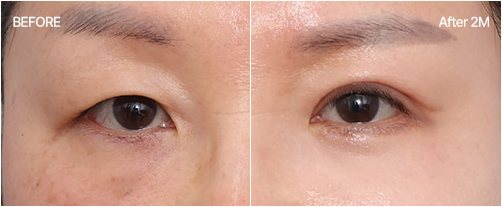 눈밑지방재배치 전후 2 — BEFORE / After 2M