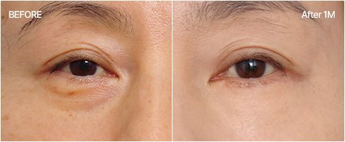 눈밑지방재배치 전후 3 — BEFORE / After 1M