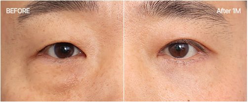 눈밑지방재배치 전후 4 — BEFORE / After 1M
