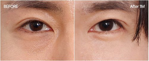 눈밑지방재배치 전후 5 — BEFORE / After 1M