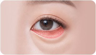 1단계 — 눈 안쪽 결막 절개선 표시