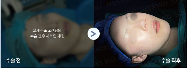 광대 수술 전·수술 직후