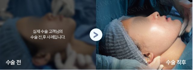 사각턱 수술 전·수술 직후