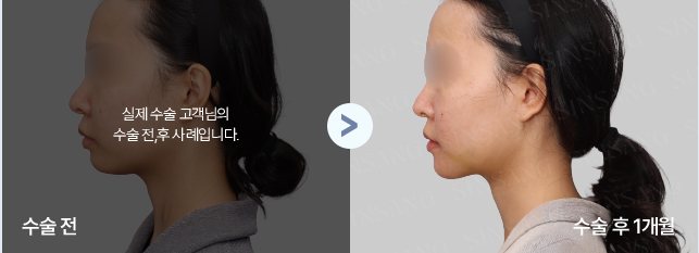 턱끝 수술 전·수술 후 1개월