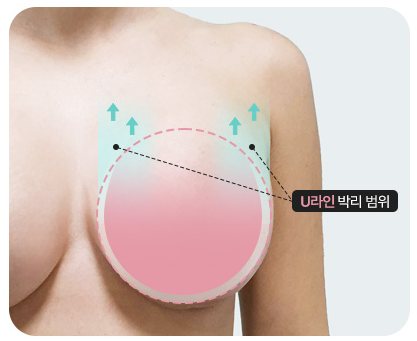 U라인 박리 범위 도식