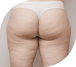 시술부위 힙