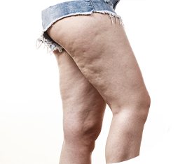 시술부위 허벅지