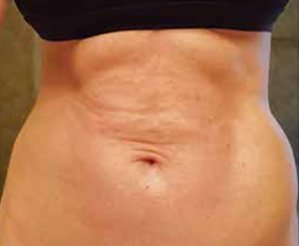 복부 CASE(하이데피니션) 시술 전