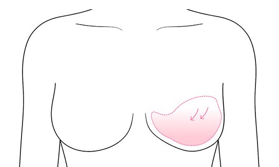 보형물 파손·변형 의심 가슴 선 일러스트