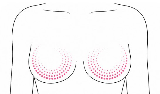 기존 수술에 의한 감각 이상 가슴 선 일러스트