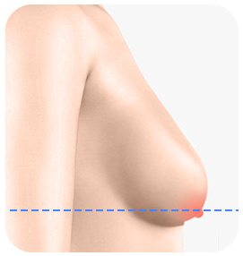 유방 하수 3급 측면 일러스트