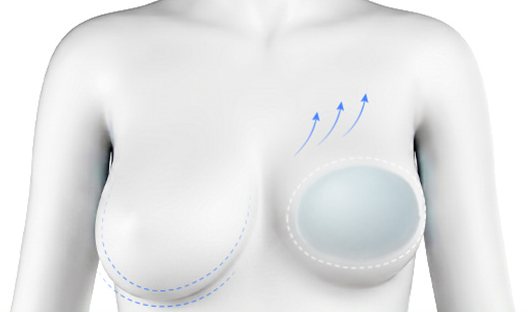 처진 조직 끌어올림과 보형물 삽입 일러스트