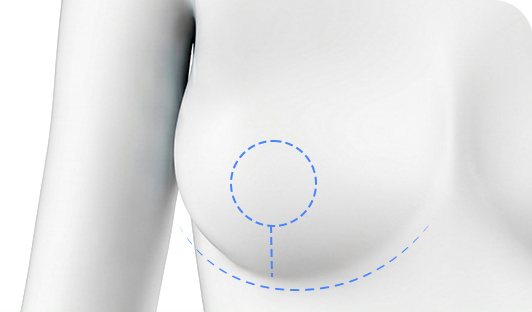 흉터 최소화 절개선 일러스트
