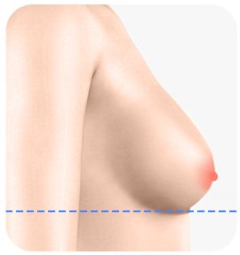 유방 하수 1급 측면 일러스트