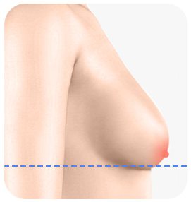 유방 하수 2급 측면 일러스트