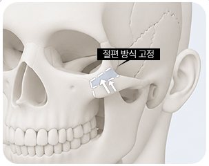 광대 절편 방식 고정 두개골 일러스트