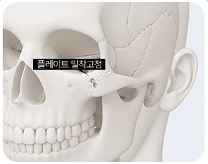플레이트 밀착고정 두개골 일러스트