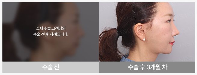 턱끝 수술 전 / 수술 후 3개월 차 (여성)
