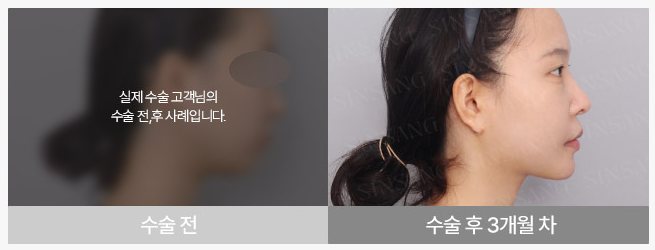 턱끝 수술 전 / 수술 후 3개월 차 (여성)