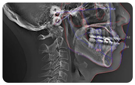 3D CT 두개골 측면 영상