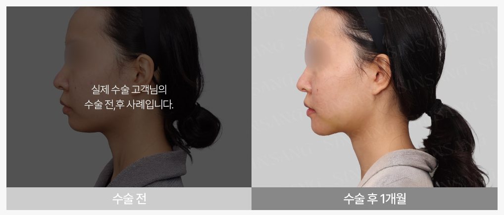 턱끝 수술 전 / 수술 후 1개월 측면