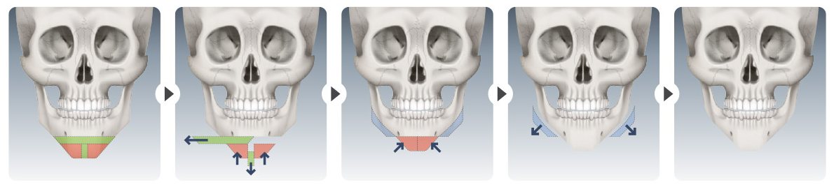 CASE 02 턱이 긴 경우 수술 과정 도식