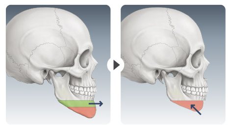 CASE 04 주걱턱 수술 도식