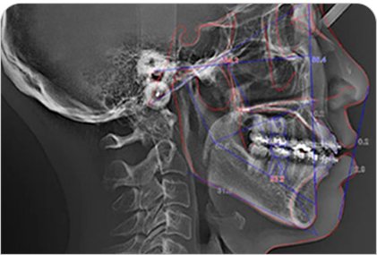 3D CT 측면 영상