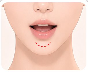 입안 최소 절개 부위 일러스트