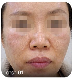 이물질 부작용 사례 case.01 얼굴 사진