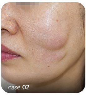 이물질 부작용 사례 case.02 볼 사진