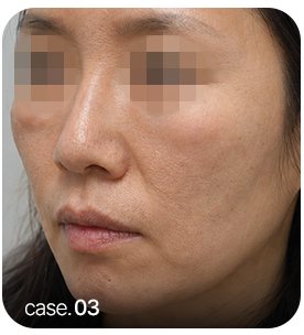 이물질 부작용 사례 case.03 얼굴 측면 사진