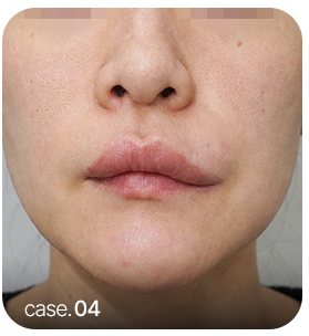 이물질 부작용 사례 case.04 입술 사진