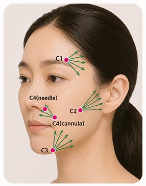 C 코드(Contouring) 시술 포인트 C1~C4