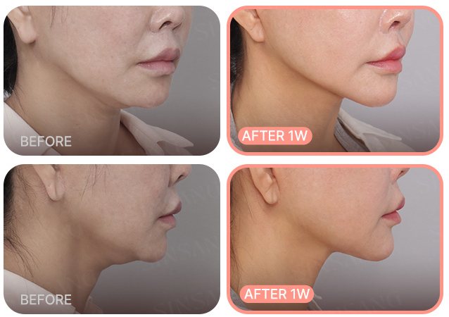 이중턱 전후 사례 3(BEFORE / AFTER 1W)