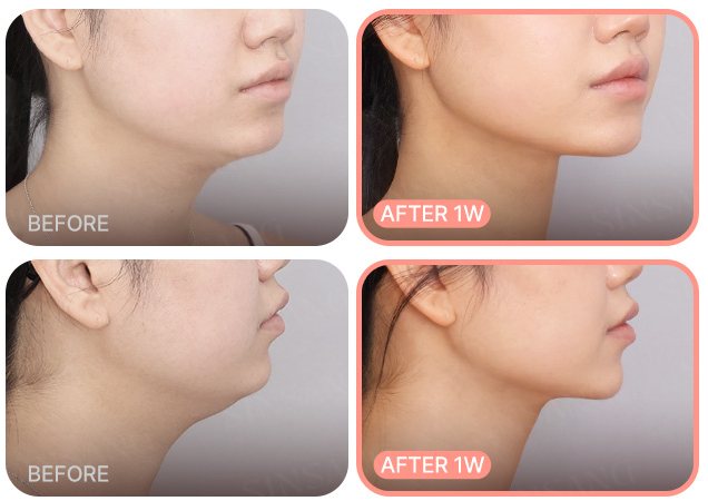 이중턱 전후 사례 4(BEFORE / AFTER 1W)