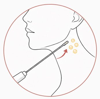 초미세 캐뉼라 지방흡입 일러스트