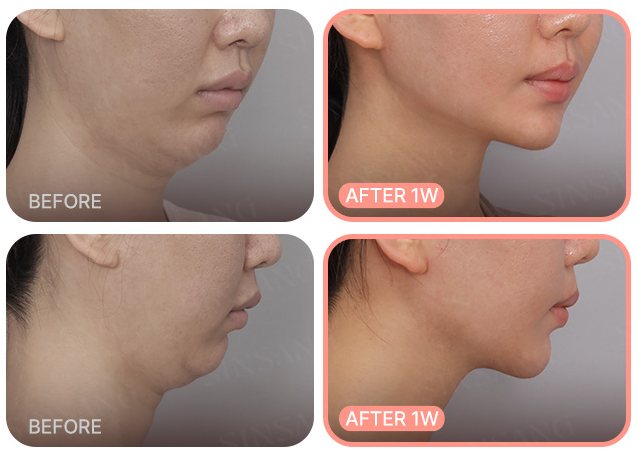이중턱 전후 사례 1(BEFORE / AFTER 1W)