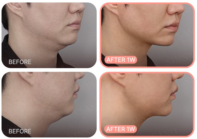 이중턱 전후 사례 2(BEFORE / AFTER 1W)