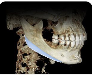 보형물이 이식된 3D CT 영상
