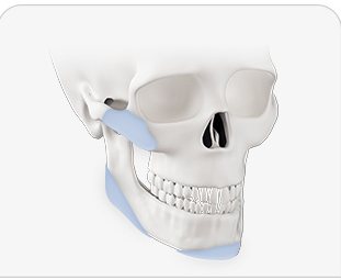3D 프린팅 보형물 두개골 일러스트