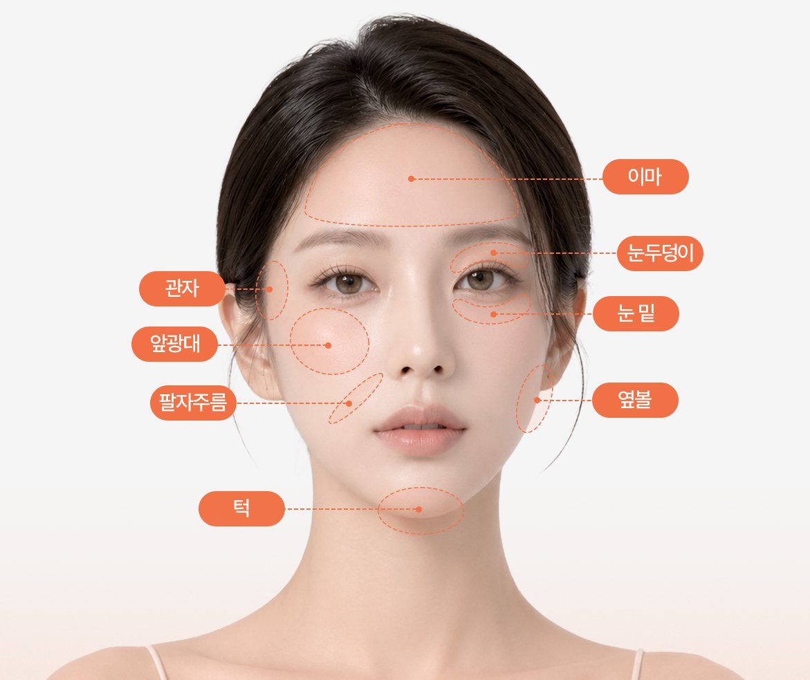 얼굴지방이식 수술 부위 표시 모델 도식