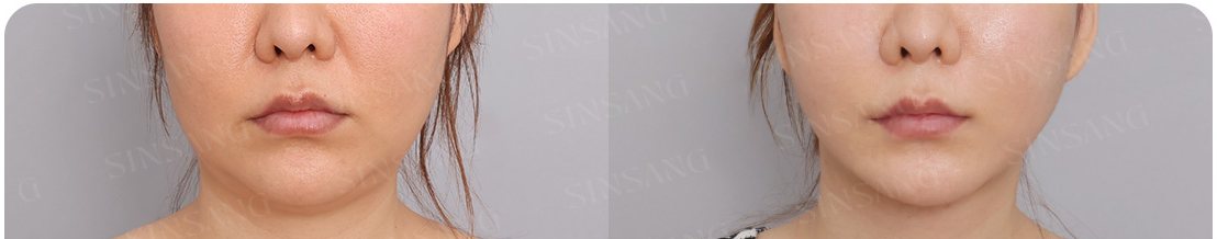 팔자 지방이식 전후(1개월 후)